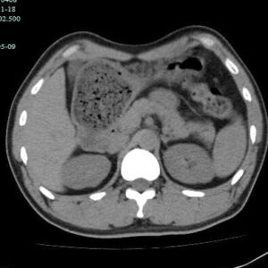 慢性胃炎：症状、原因与治疗全攻略